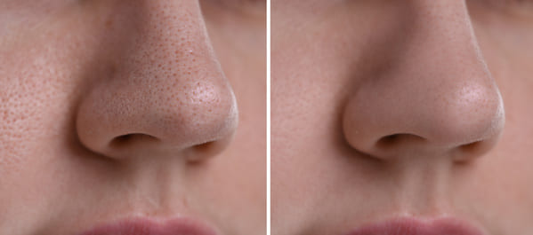 Eliminate Blackheads in 10 Simple Steps