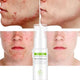 Tea tree acne cream